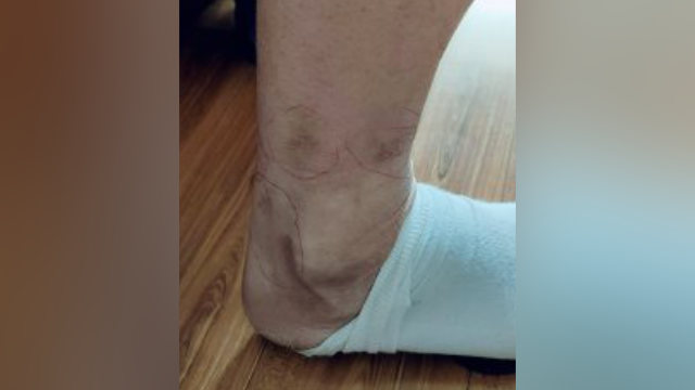 Cicatrices que quedaron en la pierna del Sr. Zhao como consecuencia de la tortura infligida con bastones eléctricos.